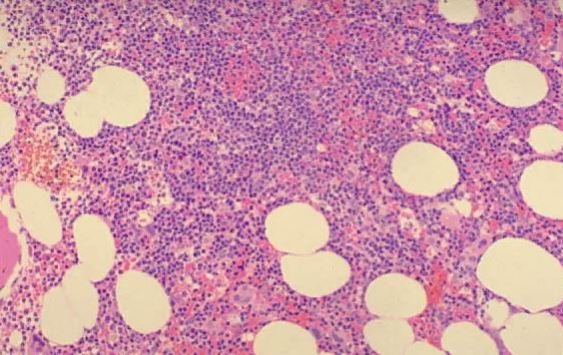 CLL infiltration with small, mature-appearing lymphocytes typical