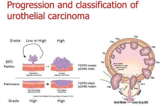 urothelial-carcinoma-low-high-grade