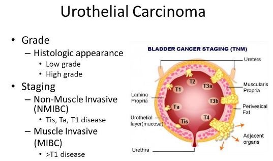 urothelial carcinoma-staging-grading