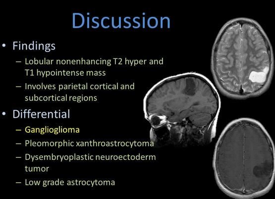 Ganglioglioma