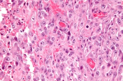 Histology of Epithelioid Sarcoma