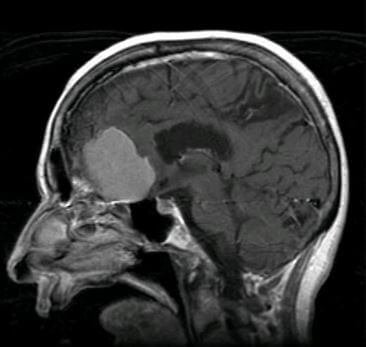 Inoperable Brain Tumor