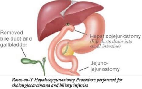 Klatskin Tumor