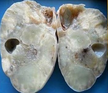 Krukenberg Tumor