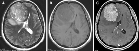 hemangiopericytoma MRI Diagnosis