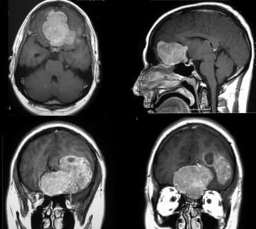 hemangiopericytoma MRI