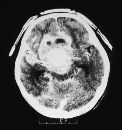 calcifications in ct scan of retinoblastoma