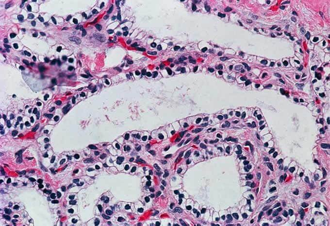 Histological findings of serous cystadenoma of ovary