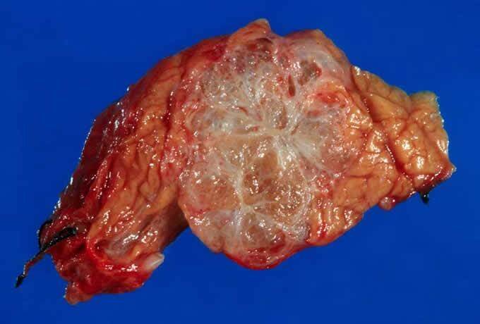 serous cystadenoma of ovary