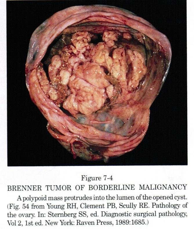 Brenner Tumor of borderline malignancy