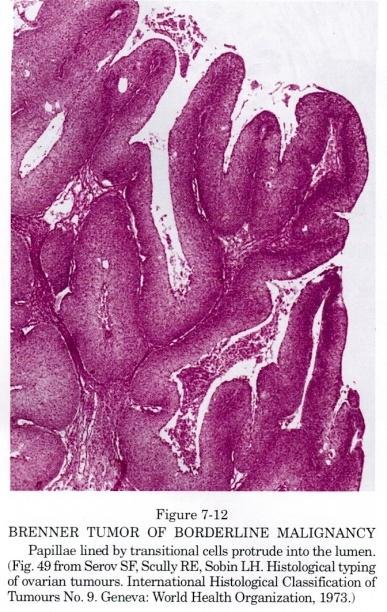 Brenner Tumor histology