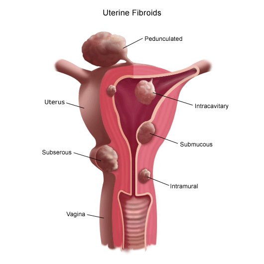 Uterine Fibroids