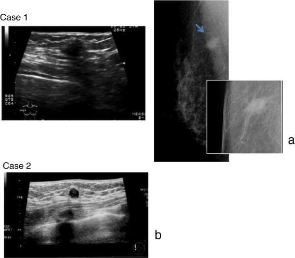 Gastrointestinal neoplasms