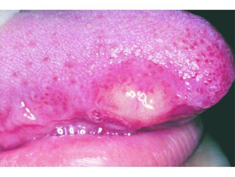 granular cell tumor tongue