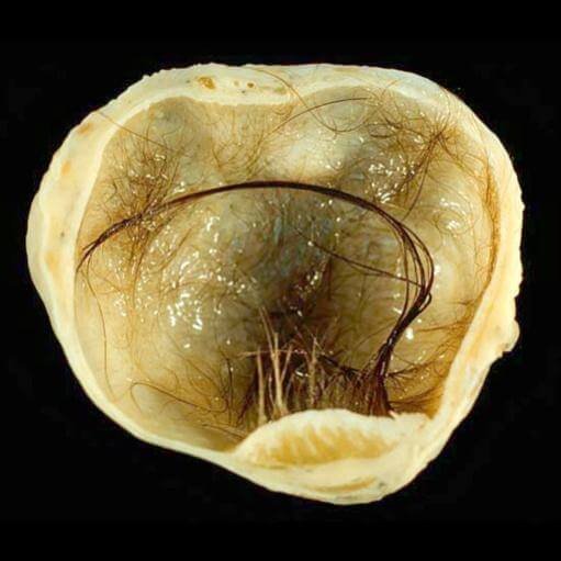 mature cystic teratoma Ovarian Teratoma