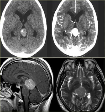 Pineal Tumor