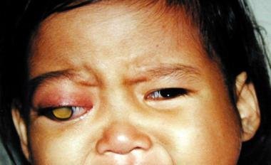 retinoblastoma