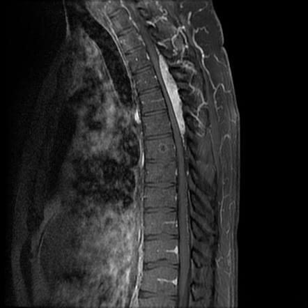 spinal angiolipoma