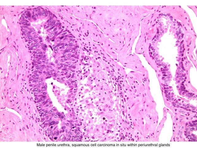 Squamous cell carcinoma