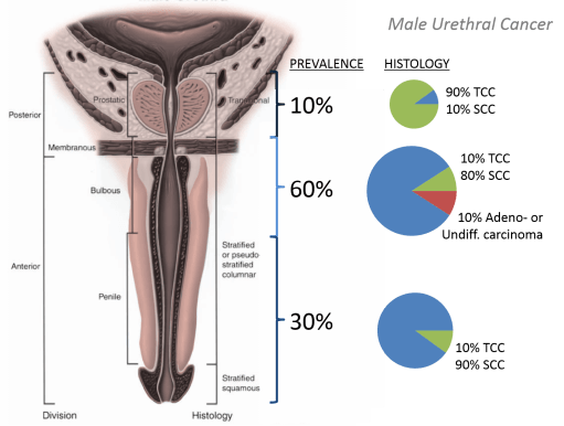 male urethral cancer