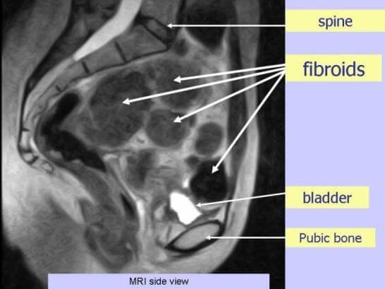 uterine fibroids ultrasound