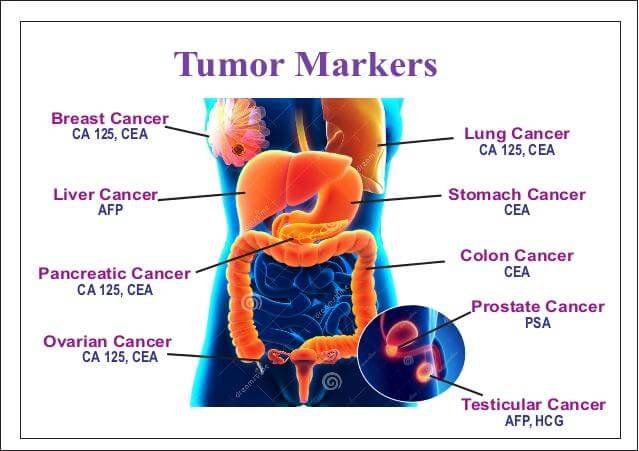 CEA Tumor Marker cancers