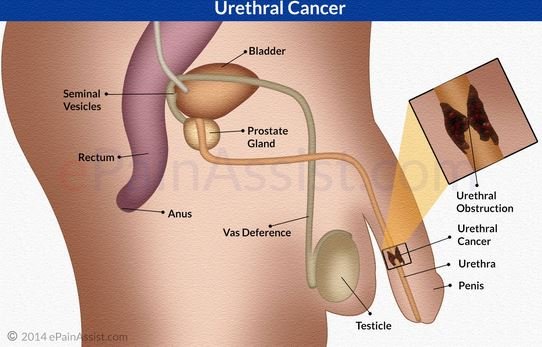 urethral cancer