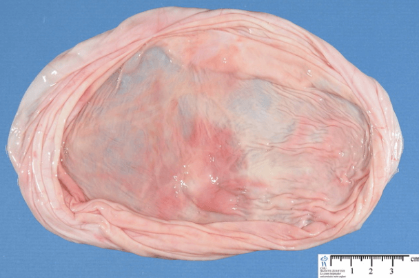 Serous Cystadenoma