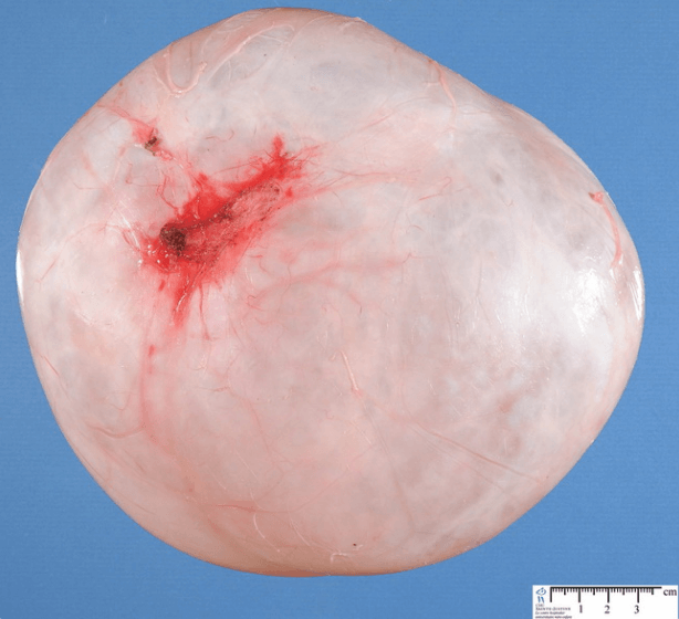 Serous Cystadenoma