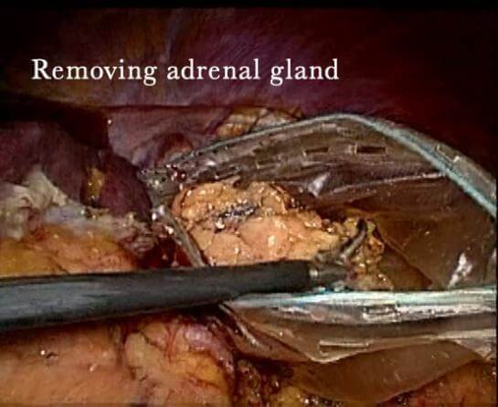 Adrenal Gland Tumor removal