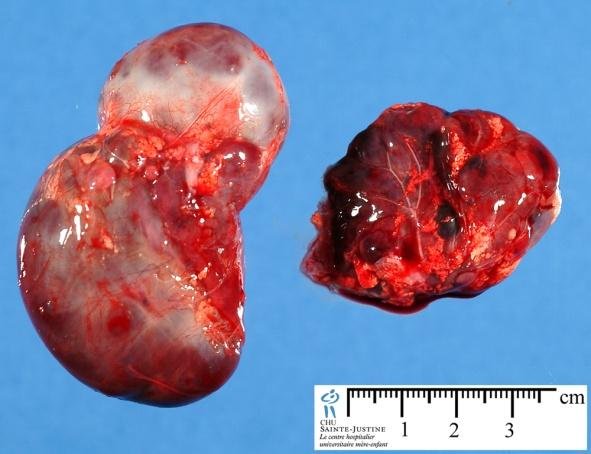 Adrenal Gland Tumor Picture 2