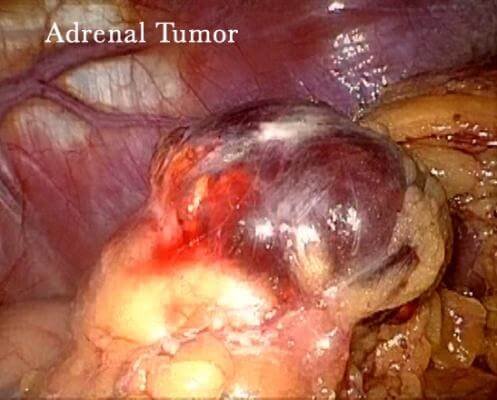 Adrenal Gland Tumor Picture 1