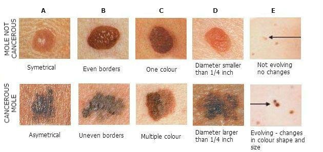 precancerous mole