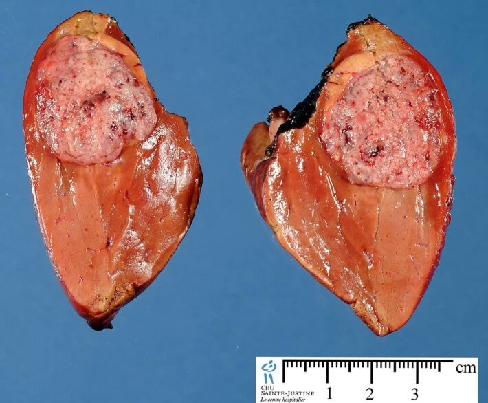 Hepatoblastoma Picture 1