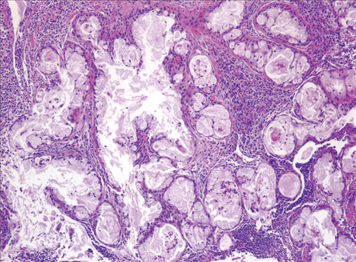 Mucoepidermoid Carcinoma Picture 2