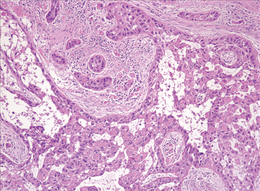 Mucoepidermoid Carcinoma Picture 3