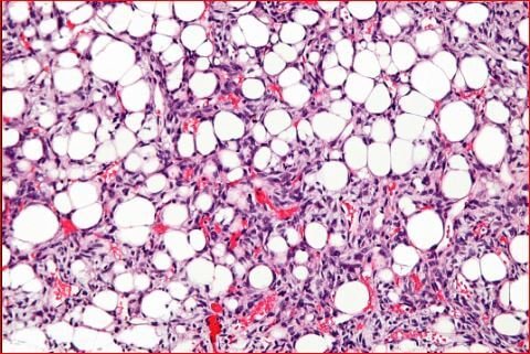 Liposarcoma Picture 1