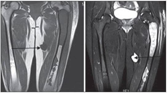  Myxoma Radiology