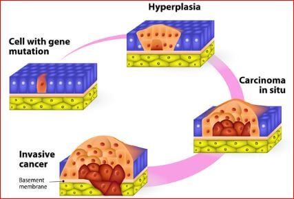 Multiple Endocrine Neoplasia Picture 1