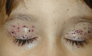 Angiokeratoma on eyes