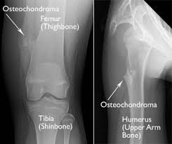 Osteochondroma 1