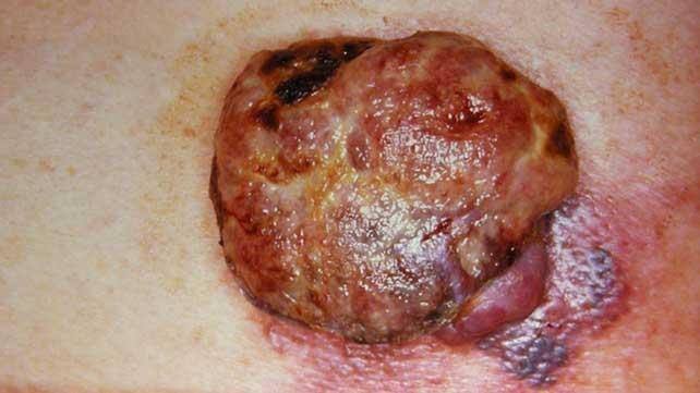 Nodular Melanoma