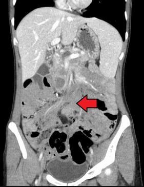 Desmoid Tumor image