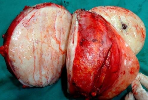 Desmoid tumor 2