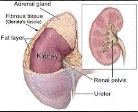 angiomyolipoma 1