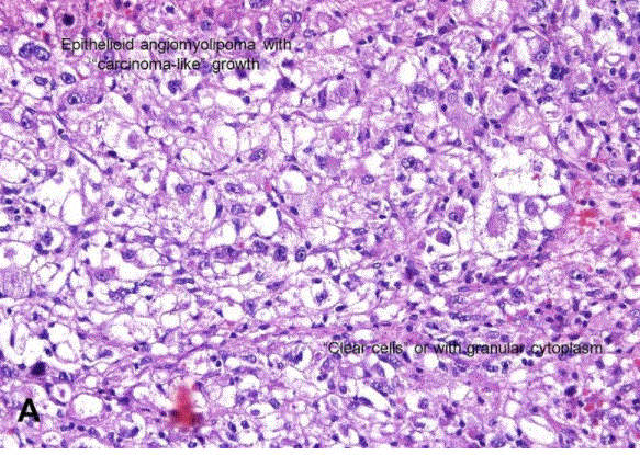 angiomyolipoma biopsy