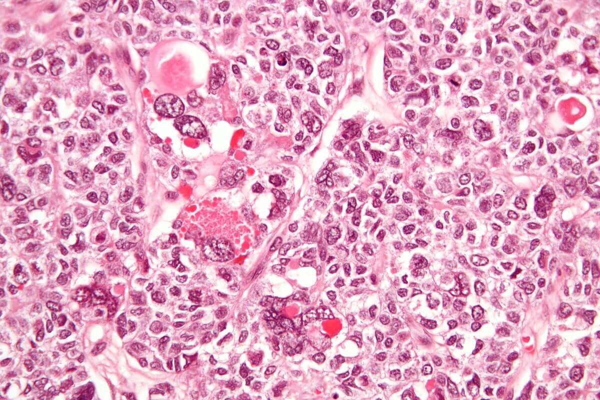 Granulosa Cell Tumor histology