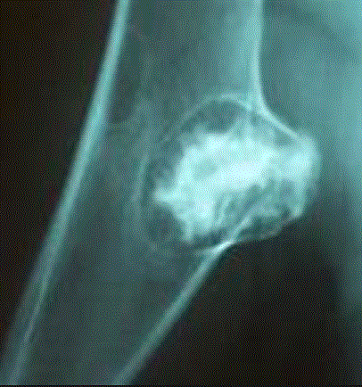 Single Osteochondroma 