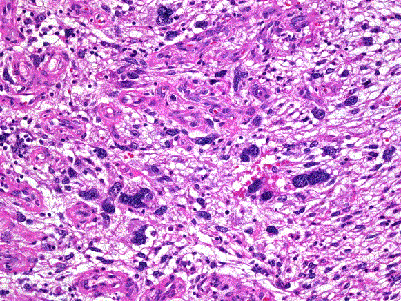 Histiocytoma 2