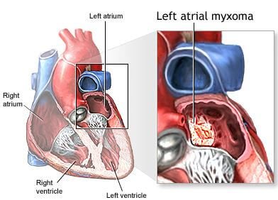 large myxoma of left atrium